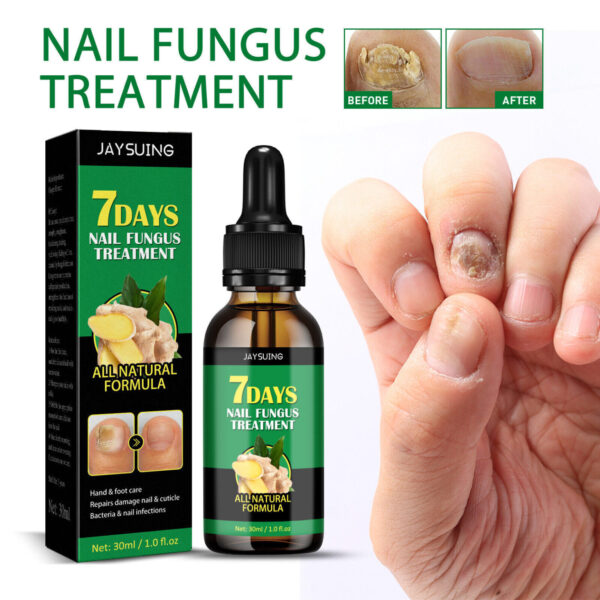 7 Days Ginger Nail Fungal Treatment Feet Care Essence - Image 2