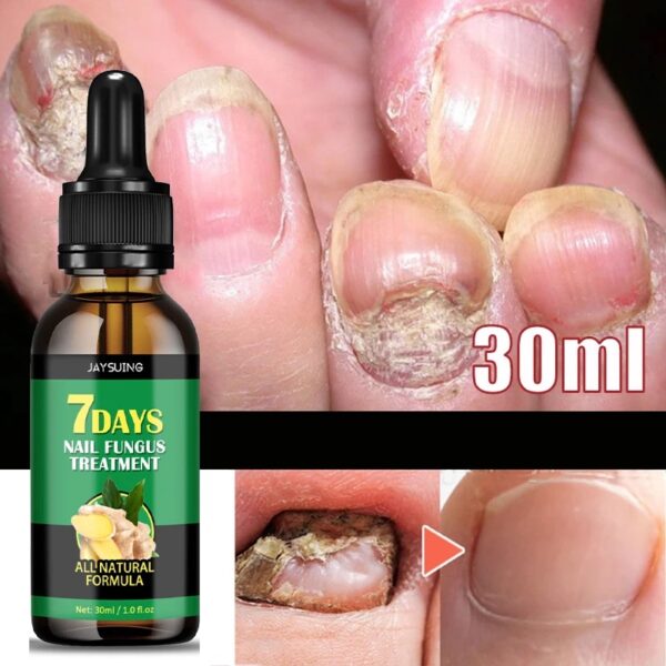 7 Days Ginger Nail Fungal Treatment Feet Care Essence